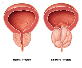 porstate-image