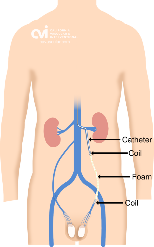 varicocele, embolization, varicocele doctor, varicocele treatment, varicocele specialist, varicocele pain