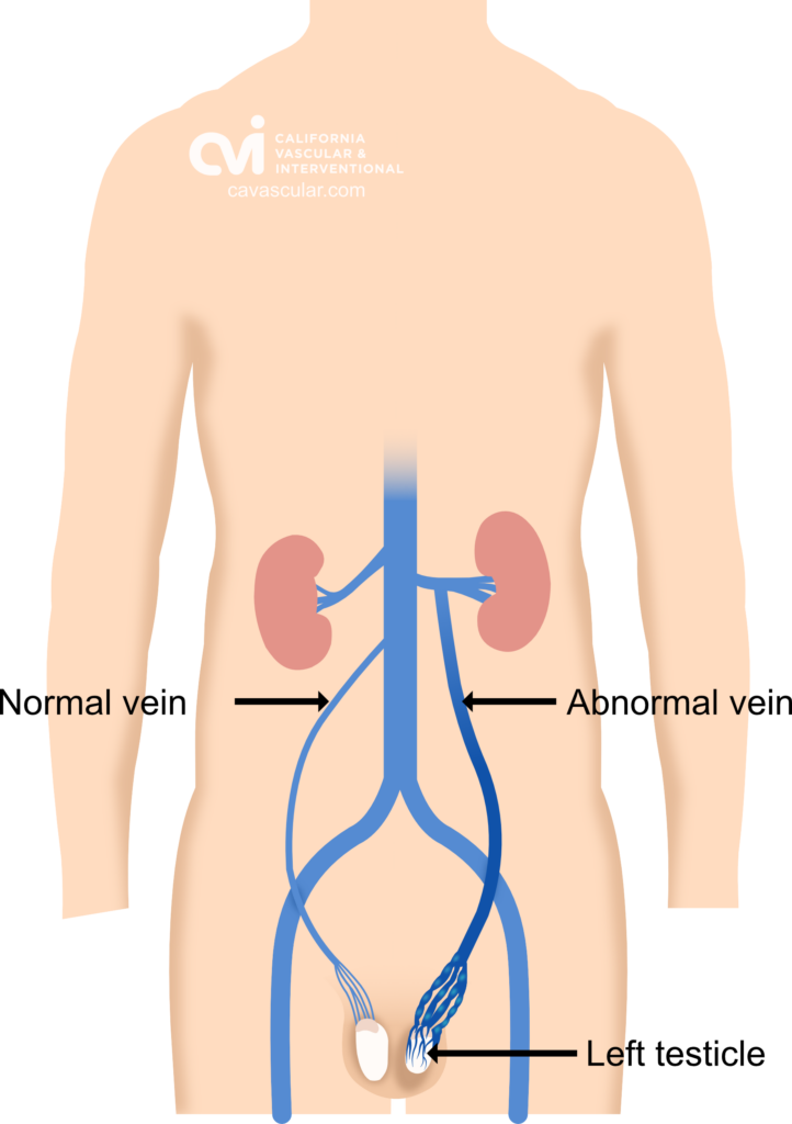 varicocele, embolization, varicocele doctor, varicocele treatment, varicocele specialist, varicocele pain