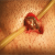 Microsurgical-varicocelectomy-Spermatic-cord-delivered-to-the-operative-field-just-01-min Microsurgical Varicocelectomy